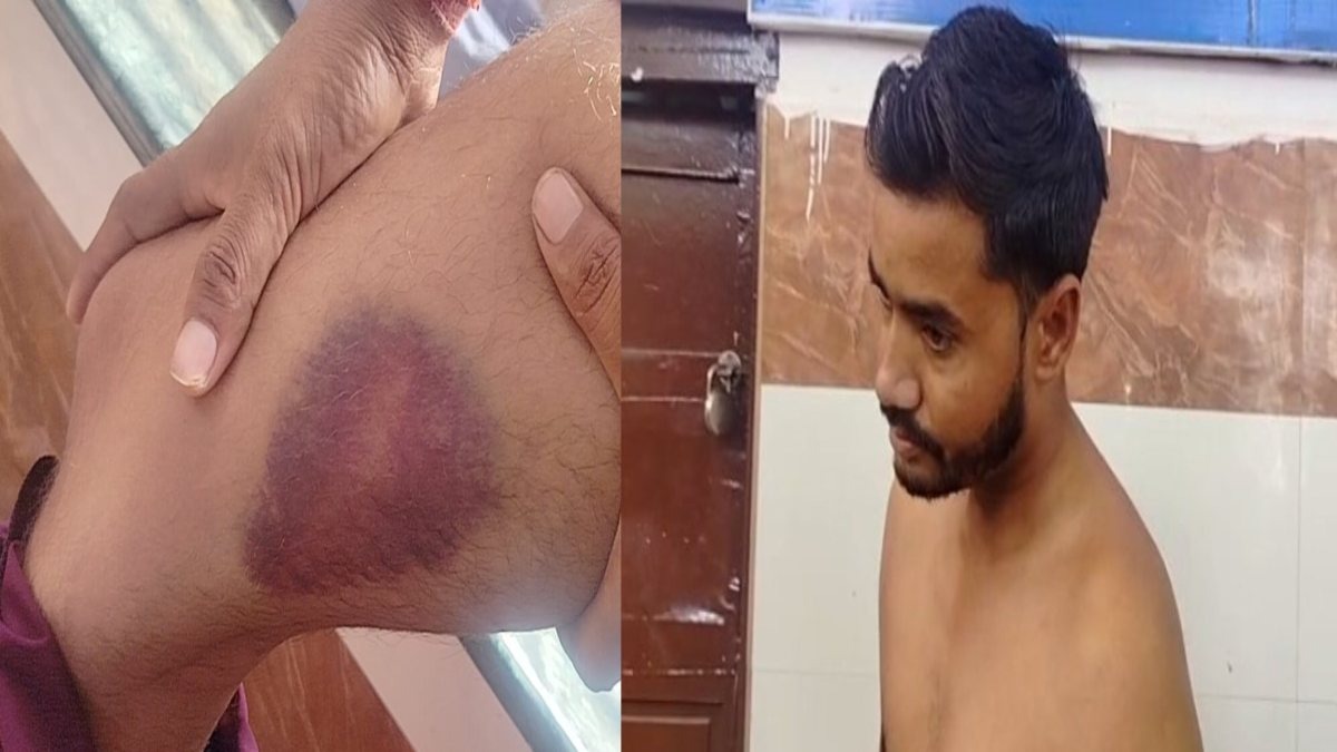 वर्दी की गर्मी: सीएम हेल्पलाइन में शिकायत करने पर पुलिस ने युवक को बेरहमी से पीटा, शरीर पर पड़े निशान, पीड़ित अस्पताल में भर्ती, शिकायत वापस लेने दी धमकी