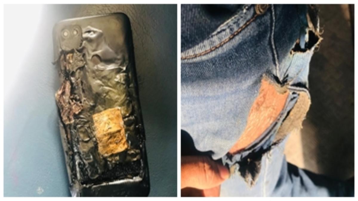Mobile Blast: पैंट की जेब में रखा था मोबाइल, अचानक फटा तो युवक की हो गई ऐसी हालत