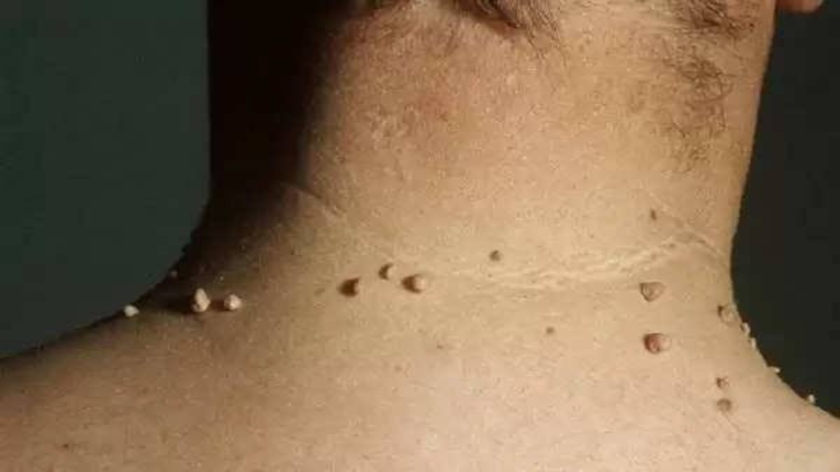 गर्दन में काले धब्‍बे और छोटे-छोटे मस्‍से इस बीमारी का देते हैं संकेत, समय रहते हुआ जा सकता है सतर्क