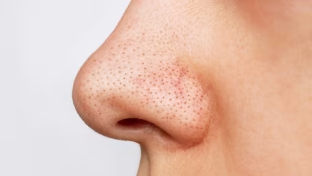 नाक पर हैं जिद्दी ब्लैकहेड्स? छुटकारा पाने के लिए आजमाएं ये घरेलू उपाय
