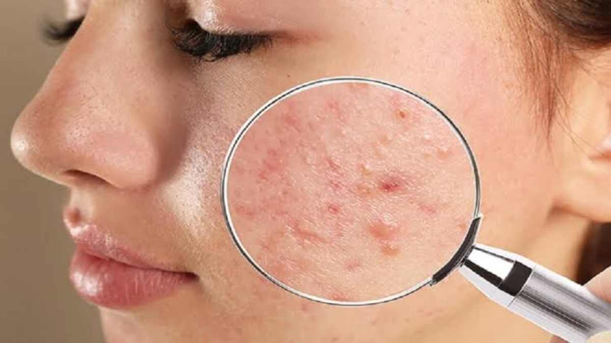 Beauty tips – चेहरे पर आने वाले पिंपल्स कर देते हैं आपको भी परेशान? ये पुराने घरेलू नुस्खें दिलाएंगे छुटकारा…