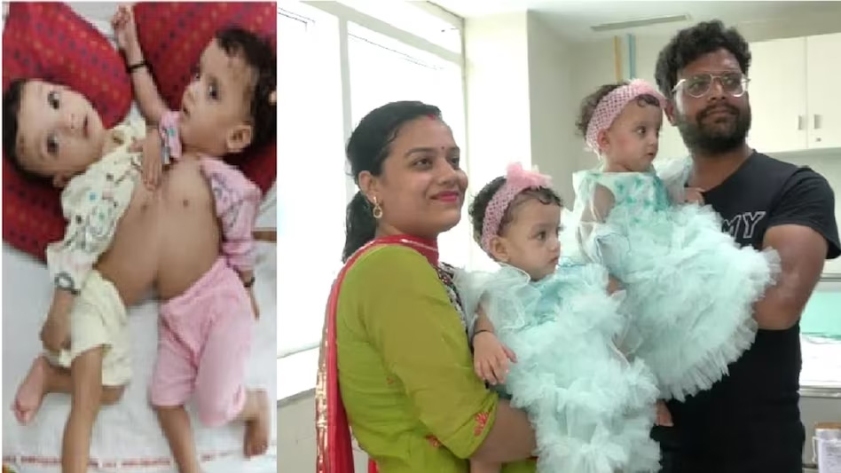 दिल्ली एम्स के डॉक्टरों ने नौ घंटे की सर्जरी के बाद छाती-पेट से जुड़ी जुड़वा बहनों की सर्जरी कर किया अलग