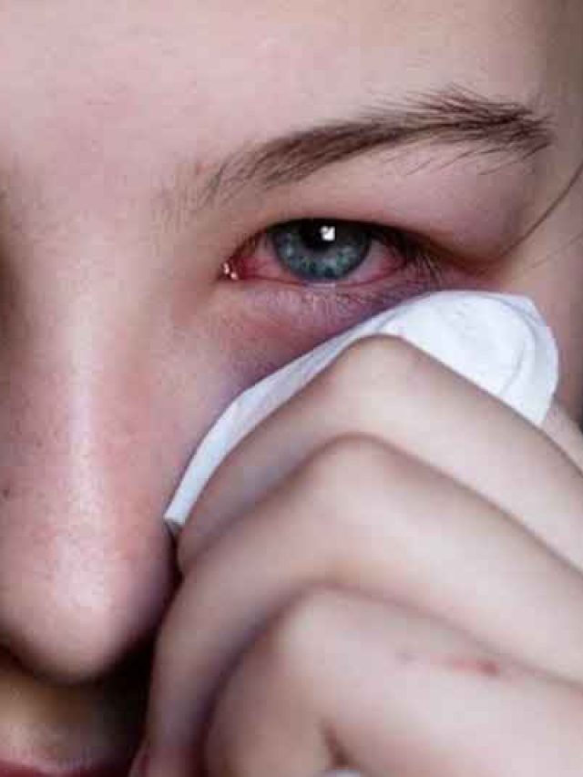 Eye Flu (Conjunctivitis) : आई फ्लू का कहर, क्या है लक्षण और कैसे करें बचाव?