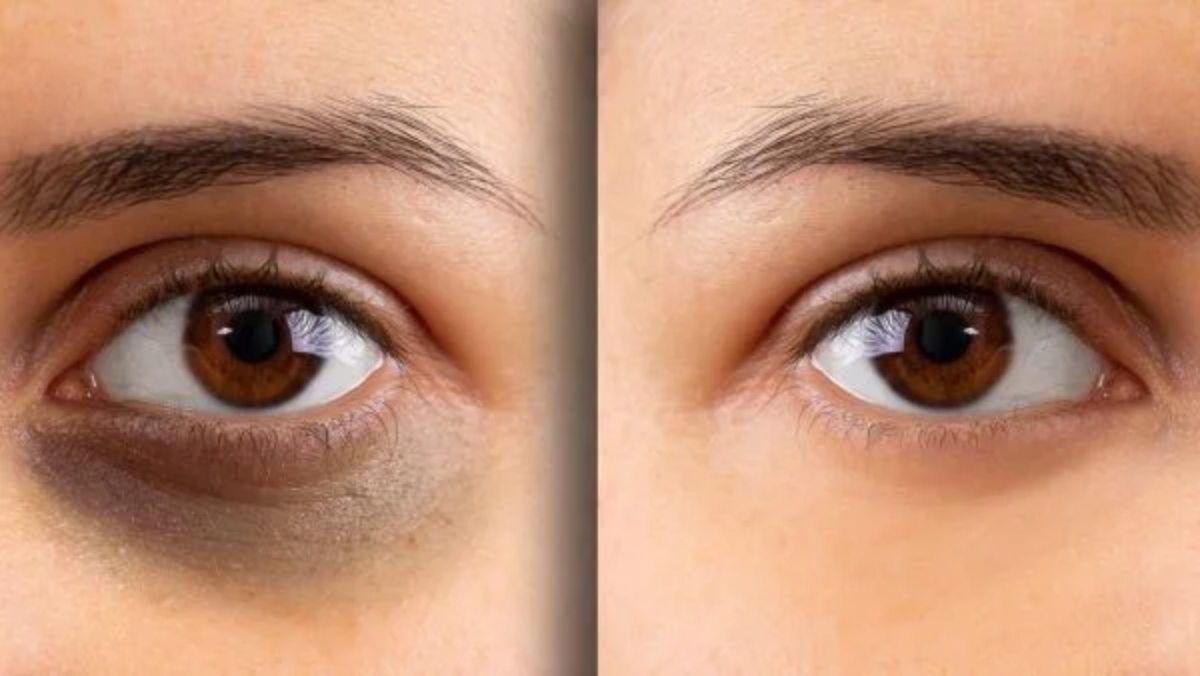 आंखों के नीचे डार्क सर्कल आना है एक बड़ी समस्या, महंगे Beauty Product के इस्तेमाल से डाइट में शामिल करें ये पोषक तत्व …