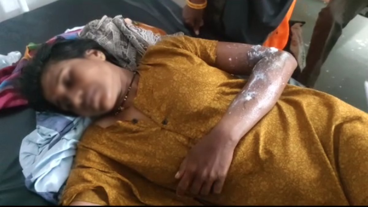 MP में एसिड अटैक: पीठ और हाथ जलने से महिला अस्पताल में भर्ती, डेढ़ साल पहले आरोपी के खिलाफ की थी शिकायत