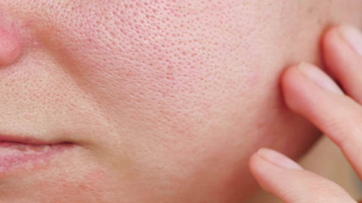 Beauty Tips : स्किन में दिखने वाले (Open Pores) घटा देते हैं चेहरे की खूबसूरती, ये सभी घरेलू नुस्खें इस समस्या से दिलाएंगे निजात …
