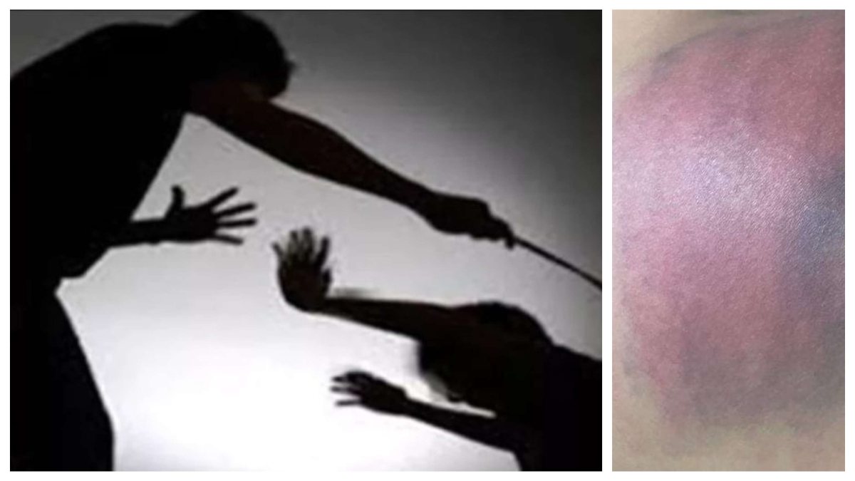 बेरहम टीचर! होमवर्क नहीं करने पर छात्र की पिटाई, परिजनों की शिकायत पर कोचिंग संचालक समेत 4 लोगों पर केस दर्ज