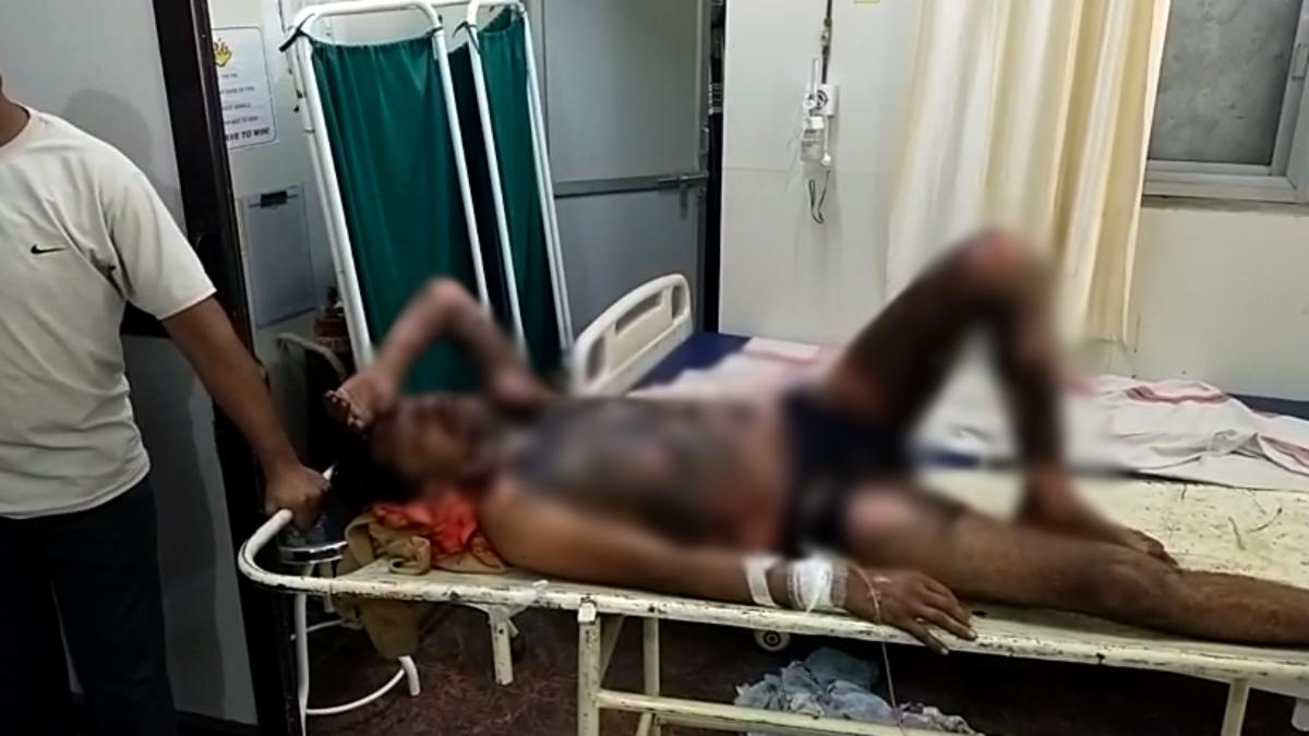 बिजली कंपनी के अधिकारियों का अमानवीय चेहरा: करंट की चपेट में आने से बुरी तरह झुलसा कर्मचारी, जिम्मेदाराें ने नहीं ली सुध