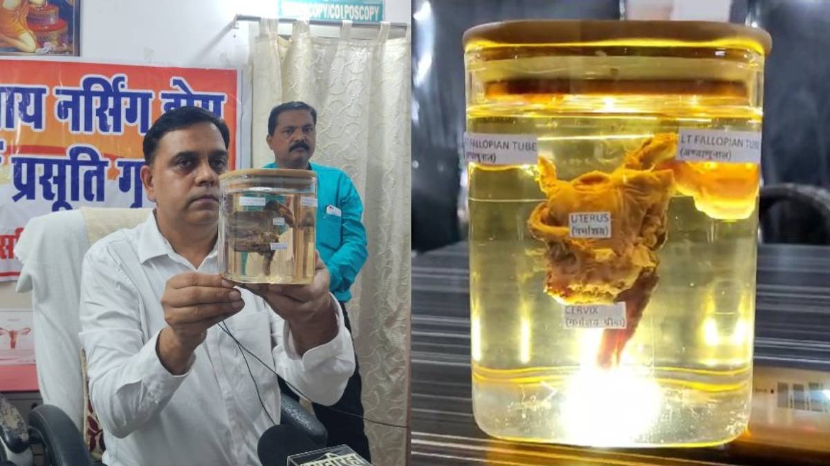 CG NEWS : छत्तीसगढ़ में पहला अनोखा मामला, युवक के पेट से निकला गर्भाशय