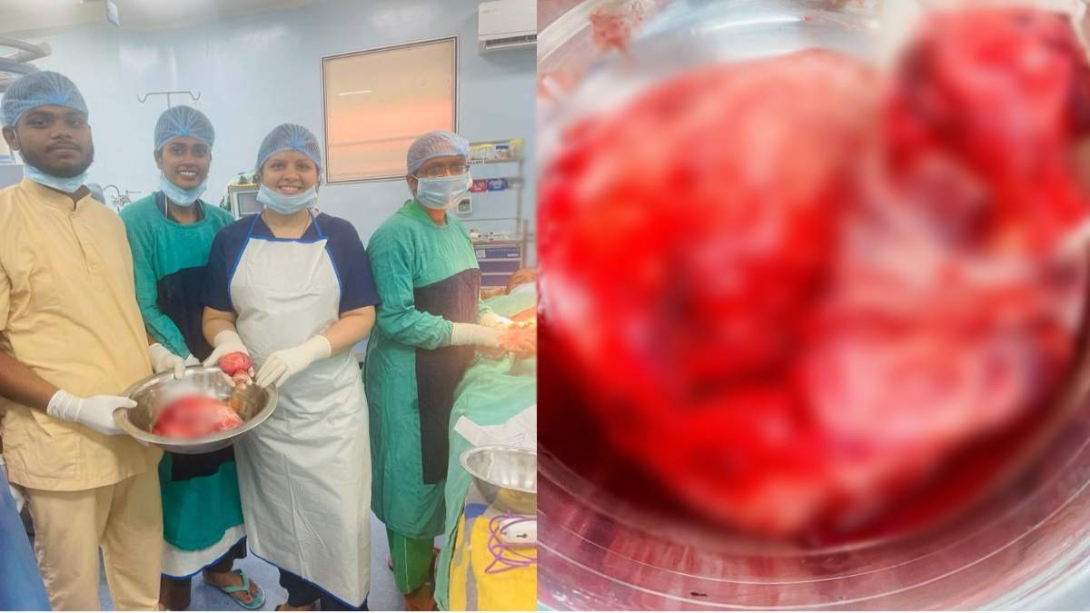 7 साल से पेट दर्द से परेशान थी महिला, डॉक्टरों ने जटिल ऑपरेशन कर निकाला 5 किलो का ओवेरियन ट्यूमर, बेहद खतरनाक होता है अंडाशय का गांठ, जानिये एक्सपर्ट से जरूरी सलाह