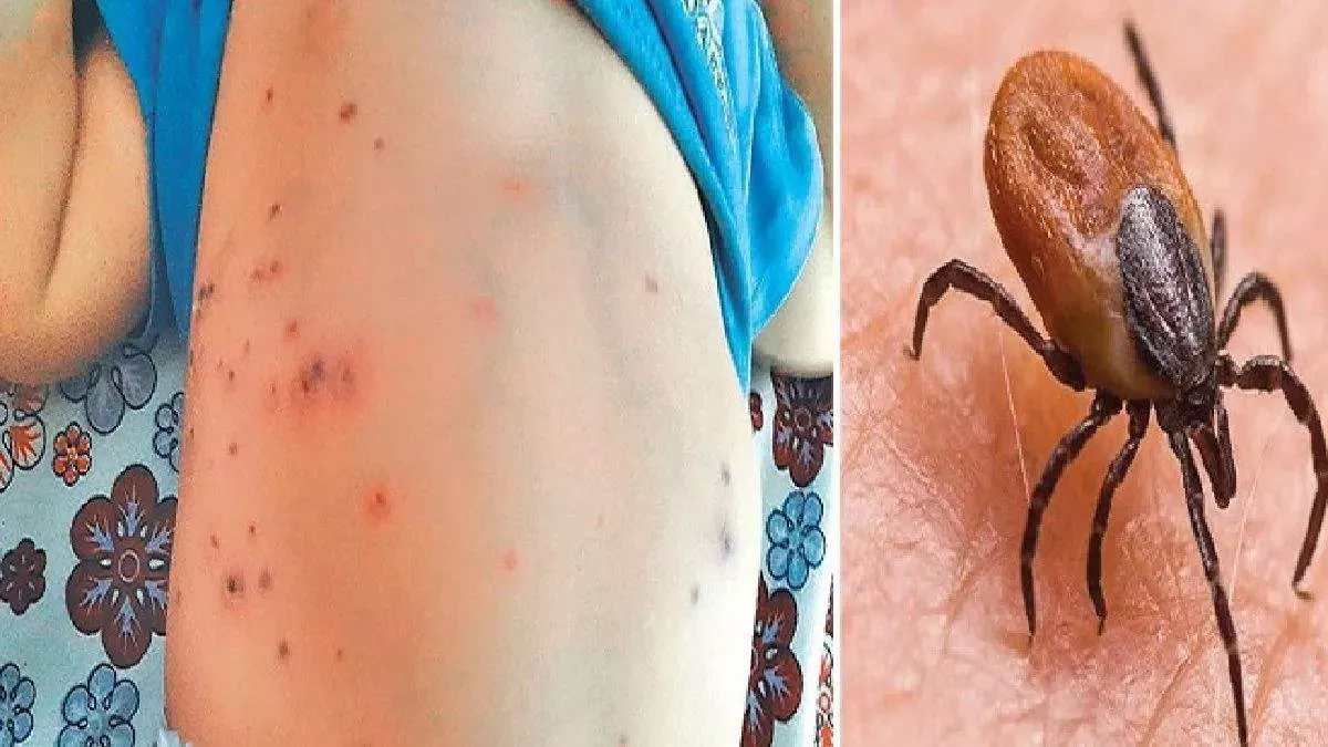 Scrub Typhus : सुंदरगढ़ में स्क्रब टाइफस के 11 नए मामले आए सामने, मरीजों की संख्या हुई 441
