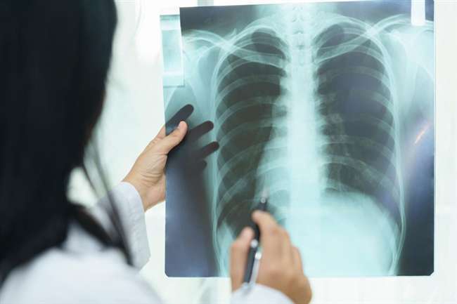 Rajasthan News: AI आधारित चेस्ट x-ray ऐप्लीकेशन शुरू, सिलिकोसिस पीड़ितों की पहचान में सहायता