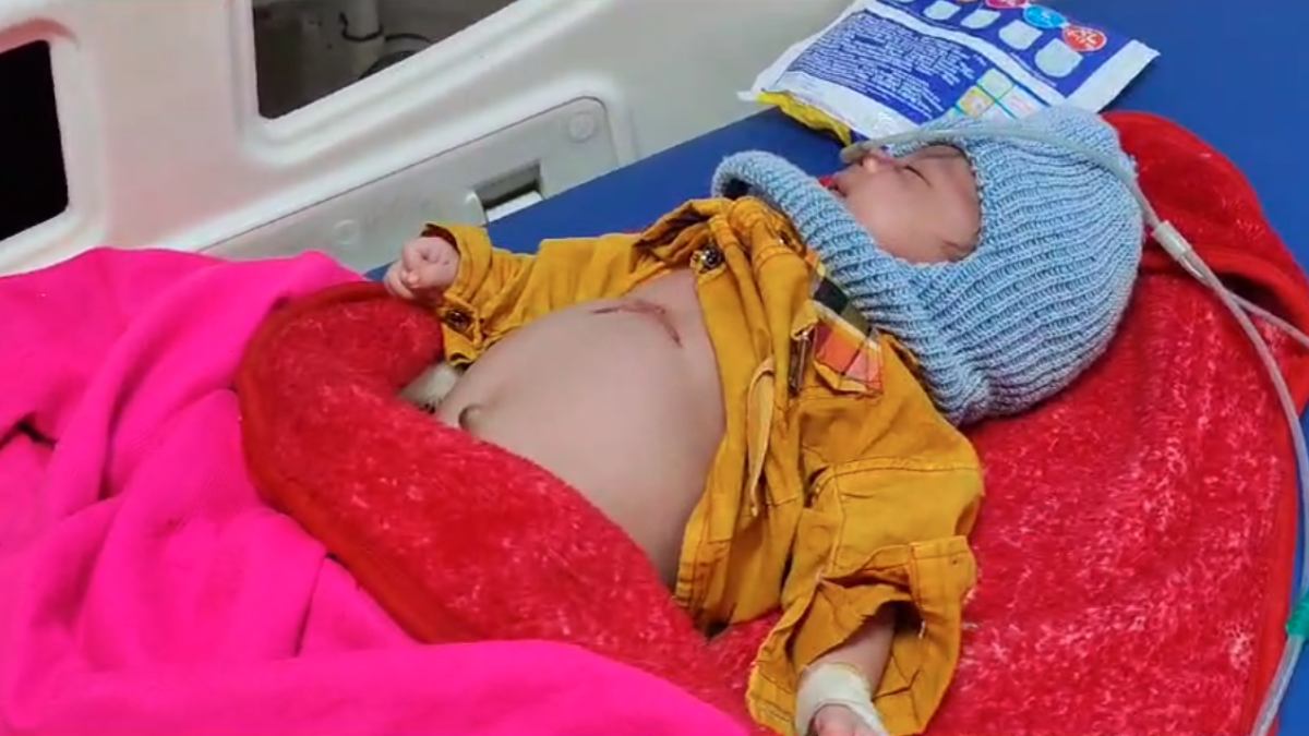 आधुनिक युग में अंधविश्वास की पराकाष्ठा: मासूम को गर्म सरिए से दागा, ऑक्सीजन सपोर्ट पर, मां का दूध भी नहीं पी पा रहा बच्चा, इंफेक्शन का डर