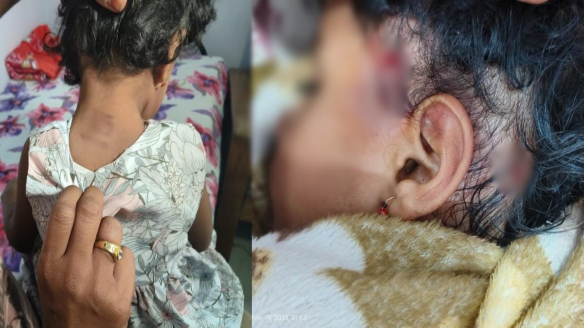 राजधानी में नहीं थम रहा कुत्तों का आतंक : ढाई साल की मासूम को झुंड ने घसीटा, शरीर पर आई कई चोट