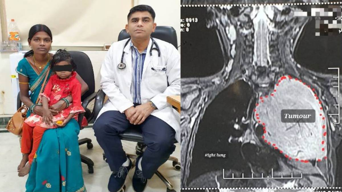 मेकाहारा में छत्तीसगढ़ के पहले सफल ऑपरेशन से मासूम को मिला नया जीवन, डॉक्टर ने सफल सर्जरी कर 3 साल की बच्ची के फेफड़े से निकाला 1.5 किलो का ट्यूमर