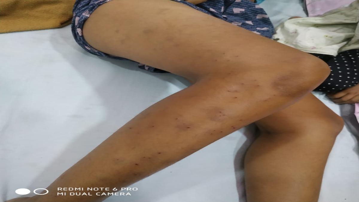 स्कूल स्टूडेंट्स में विवादः तीन बच्चों ने एक छात्र पर राउंडर से पूरे शरीर में किए सैकड़ों बार प्रहार