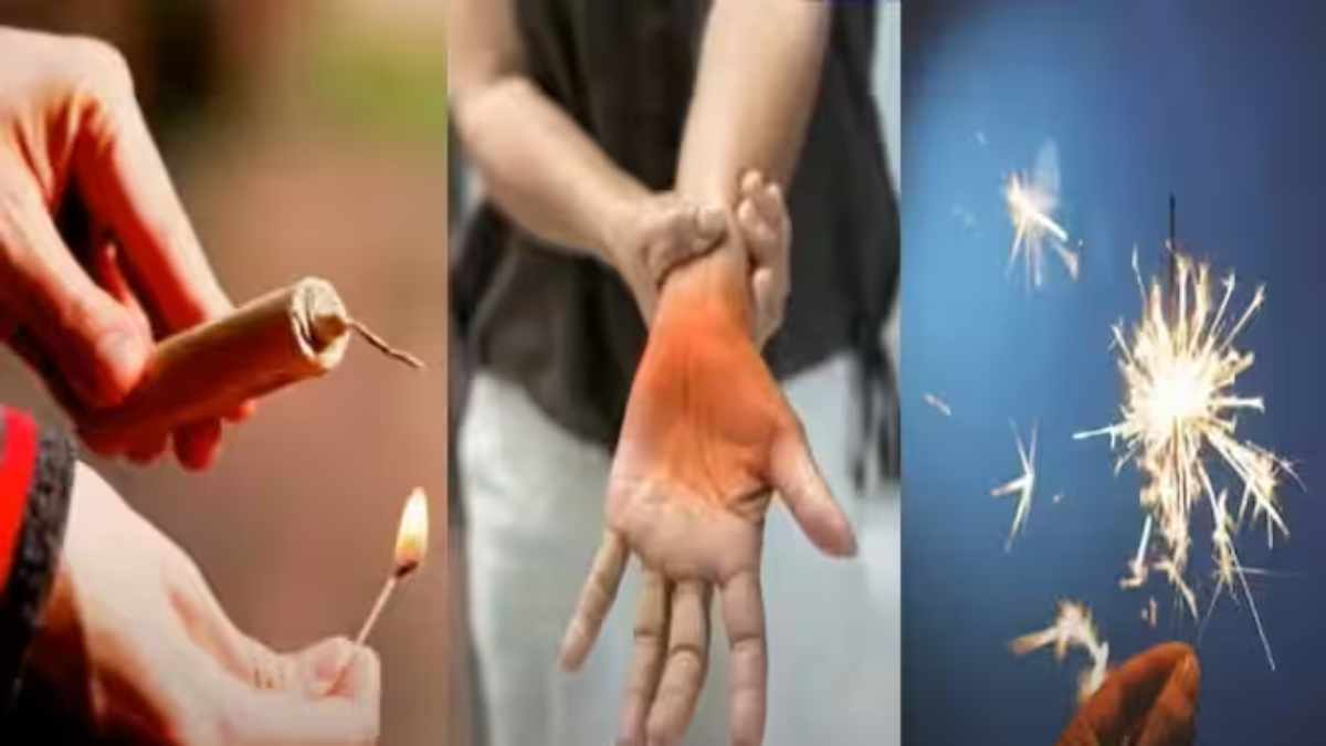 दिवाली पर पटाखे या दीये से जल जाएं तो क्या करें, जानें 5 जरूरी बातें…, भूलकर भी न लगाएं टूथपेस्ट…