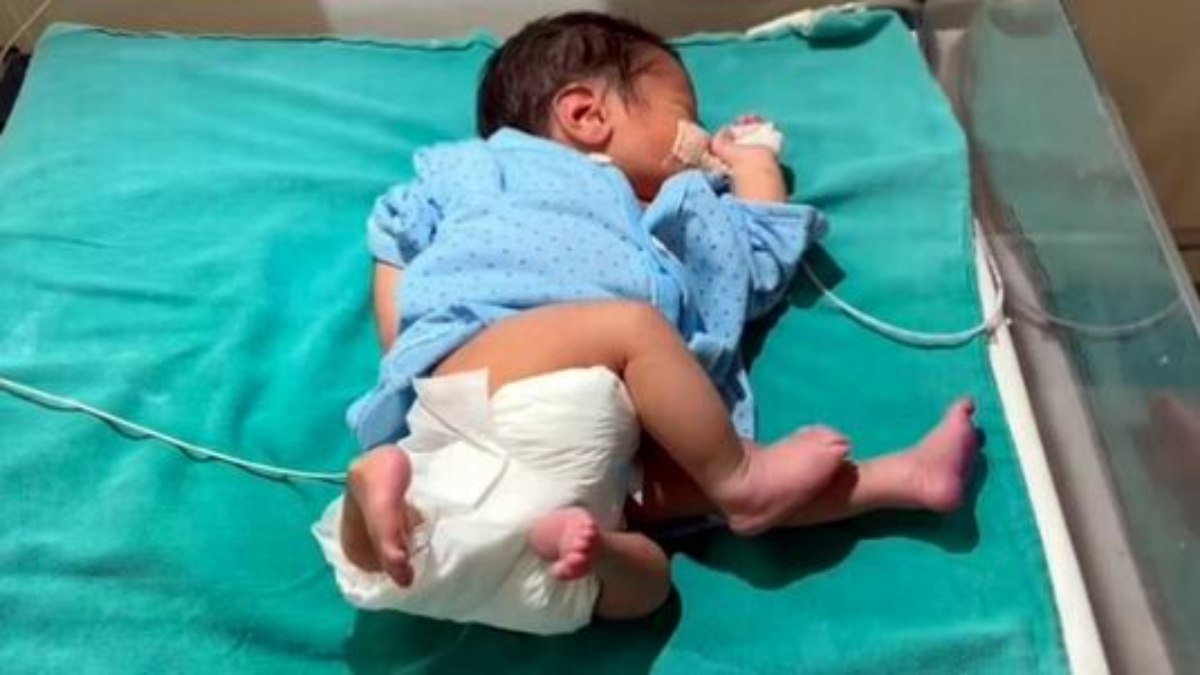 यहां जन्मा 4 पैर, 4 हाथ और 2 गुप्तांग वाला बच्चा, जानिए डॉक्टरों ने क्या कहा…