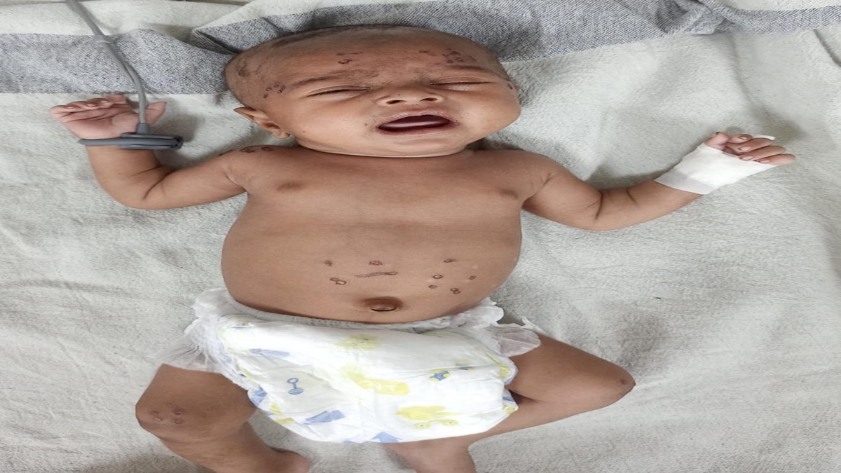 मासूम को गर्म सलाखों से दागा: बंद नहीं हो रही यह कुप्रथा, अंधविश्वास की वजह से कई बच्चों की हो चुकी है मौत