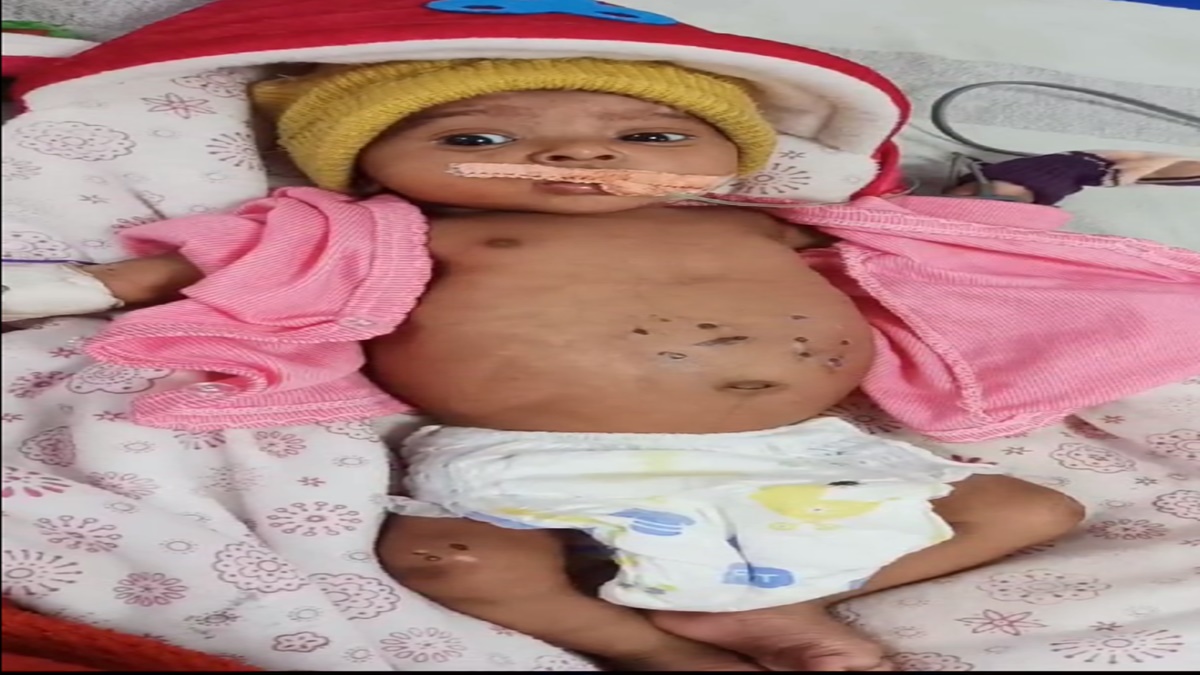 मासूम को गर्म सलाखों से दागने वाले परिवार पर FIR: अंधविश्वास की वजह से कुप्रथा को बढ़ावा दे रहे ग्रामीण, बच्चे का अस्पताल में इलाज जारी