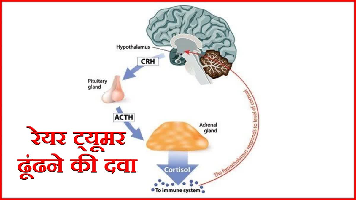 PGI News : रेयर ट्यूमर के इलाज को सरल बनाने एम डेस्मो नाम के इंजेक्शन का शोध
