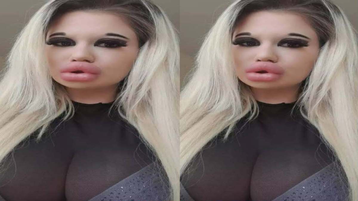 दुनिया की “सबसे बड़े होंठों वाली महिला” ने फिर करवाई सर्जरी, अब तक करा चुकी 27 बार सर्जरी