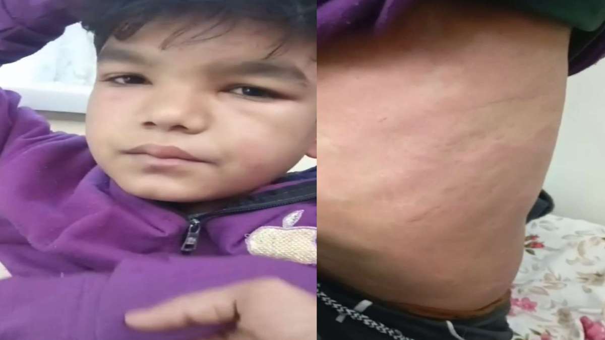 सिरप पीने से बिगड़ी बच्चे की तबीयत: शरीर पर पड़े लाल निशान, PICU में भर्ती
