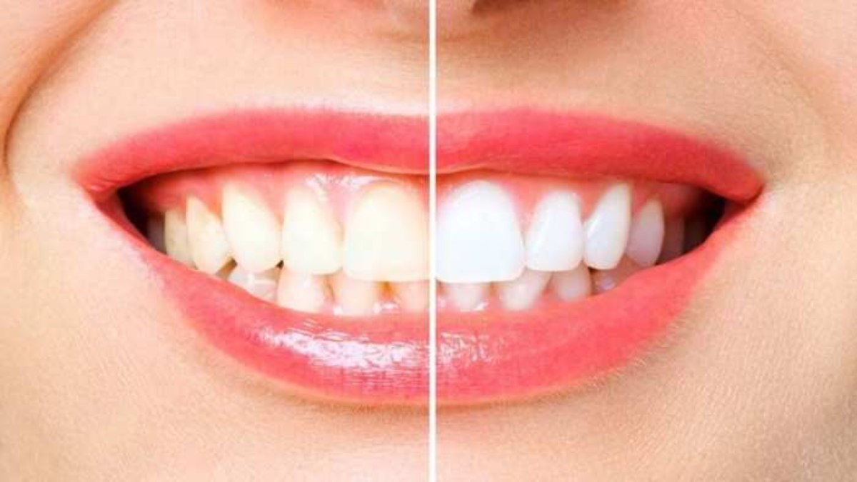Teeth Whitening Tips: ब्रश करने के बाद भी नहीं हट रहा दांतों का पीलापन तो अपनाएं ये नुस्खा, चमक जाएंगे आपके दांत
