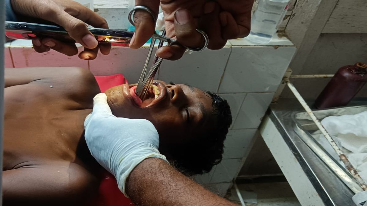 CG News : तालाब में नहाते समय बच्चे के मुंह में घुसी मछली, गले में फंसी फिश को निकालने डॉक्टर होते रहे परेशान