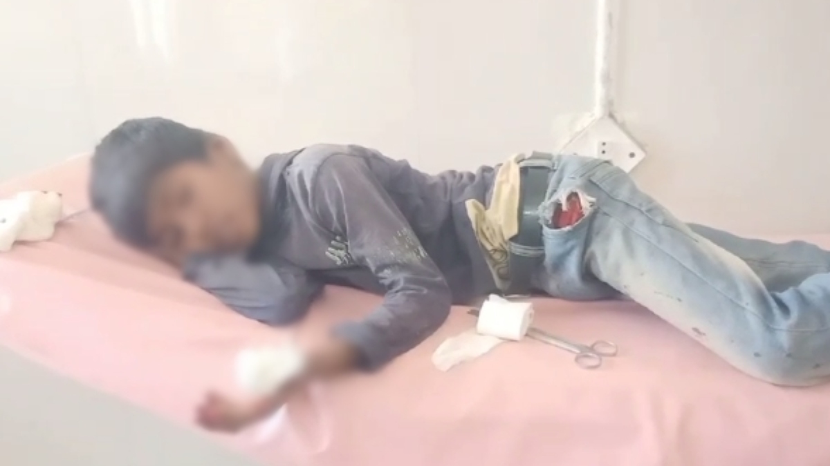पत्थर समझकर गलती से उठा लिया देसी बम: ब्लास्ट के बाद बच्चे की उड़ी उंगली, अस्पताल में भर्ती 