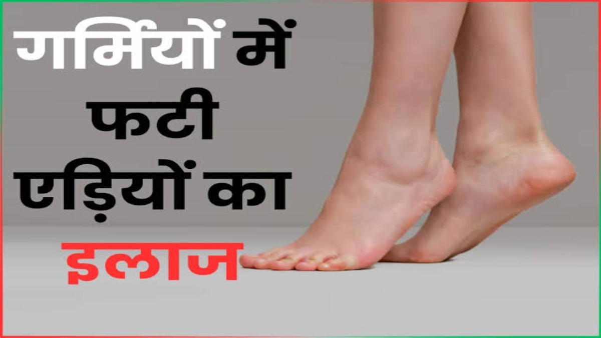 गर्मियों में फटने लगी हैं आपकी भी एड़ियां, तो इन घरेलू उपायों से पाएं इस समस्या से निजात …