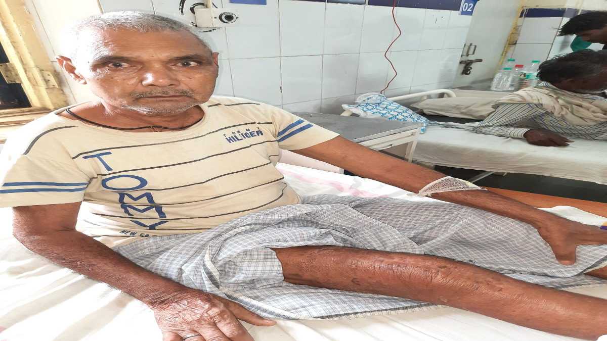 Bhopal News: जेपी अस्पताल में पहली बार घुटनों का ट्रांसप्लांट, डॉक्टरों ने की Osteoarthritis से पीड़ित बुजुर्ग की सफल सर्जरी