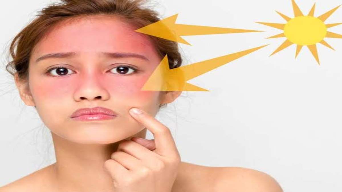 Skin care tips- घर में रखी इन घरेलू चीजों से सनबर्न से बचने में मिलेगी मदद