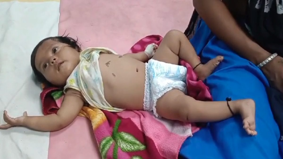 अंधविश्वास की गिरफ्त में आदिवासी: 4 माह की बच्ची को तांत्रिक ने गर्म सरिए से दागा, निमोनिया की वजह से सांस लेने में थी तकलीफ