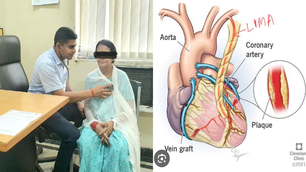 अम्बेडकर अस्पताल में  MP की 63 वर्षीय महिला की हुई जटिल सर्जरी, हार्ट में ब्लॉकेज के साथ माइट्रल और ट्राइकस्पिड वाल्व में था लीकेज