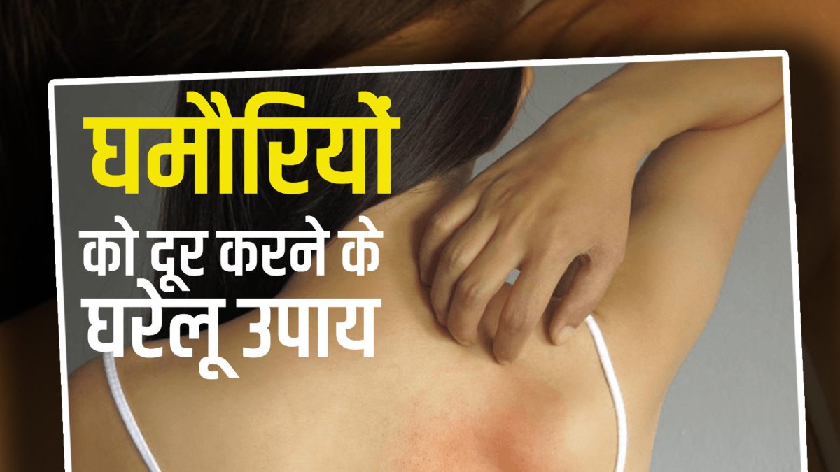 गर्मियों में घमौरियों से हो गये हैं परेशान, तो जानिए इसके घरेलु उपाय …