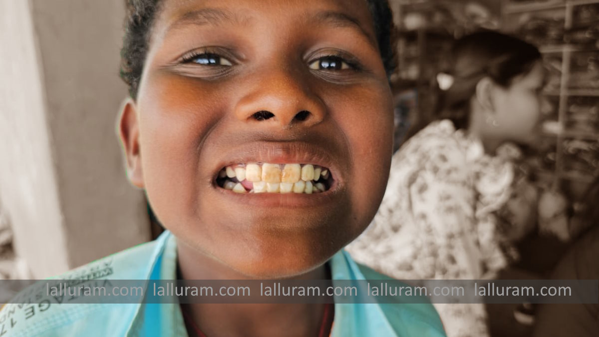 Lalluram Special : सुपेबेड़ा बनने की कगार पर गरियाबंद जिले का एक और गांव, फ्लोराइड युक्त पानी का बच्चे से लेकर बुजुर्ग तक दिख रहा असर…