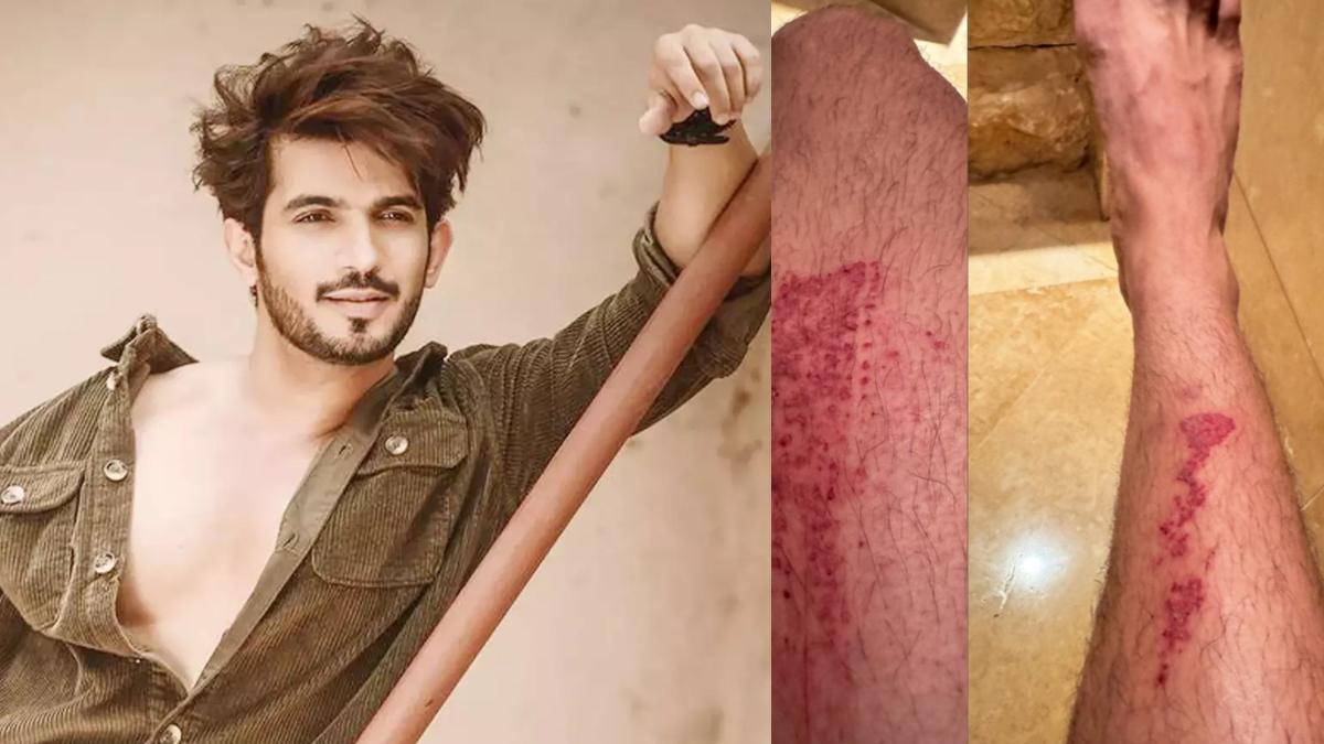 Goa में हुआ Arjun Bijlani का एक्सीडेंट, एक्टर ने शेयर की Photos …