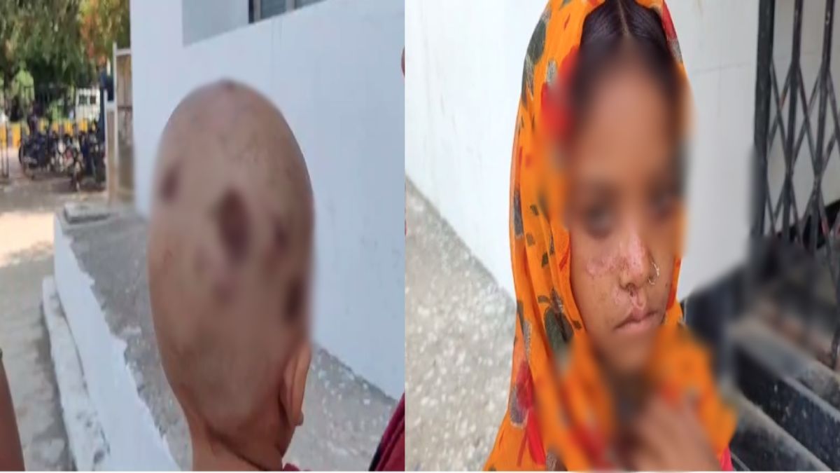 MP के इस गांव में तेजी से फैल रहा चर्म रोग: दुधमुंहे बच्चों से लेकर बुजुर्ग तक चपेट में आए, स्वास्थ्य विभाग ने दिए ये निर्देश