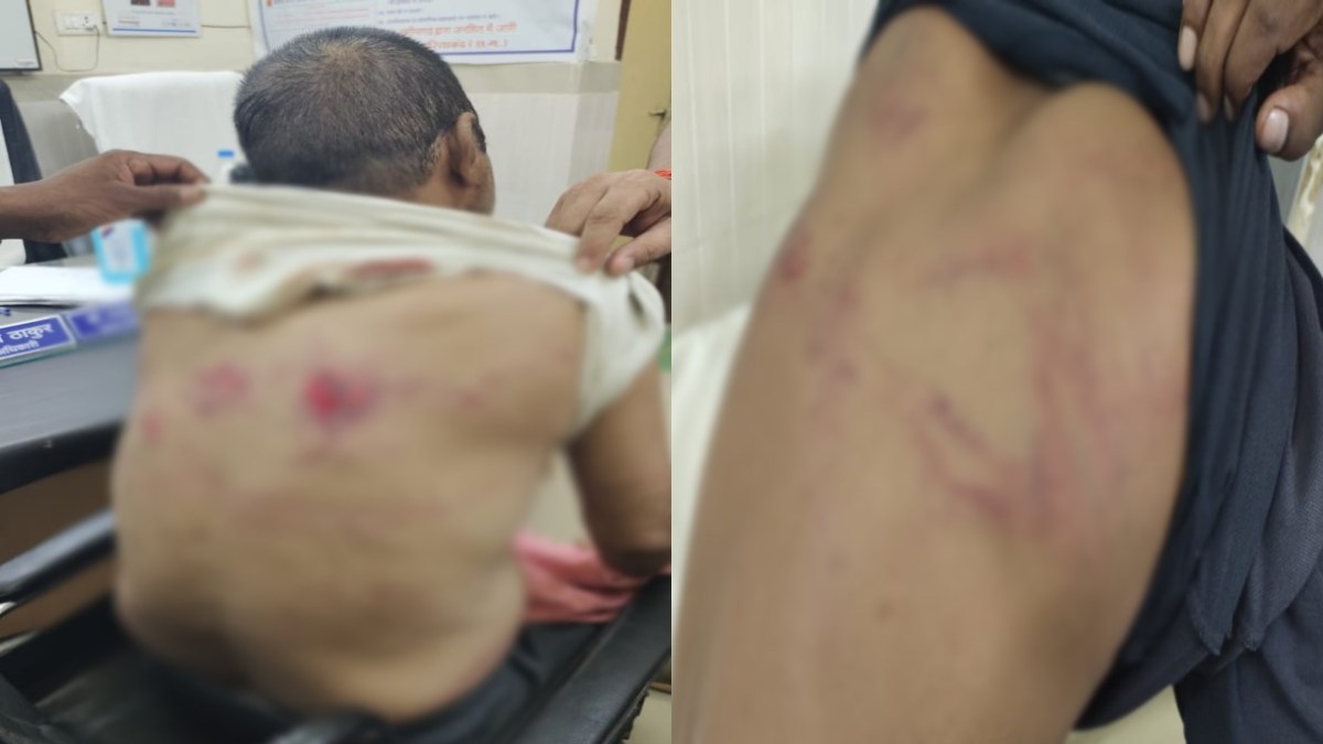 अतिक्रमण रोकने गए रेंजर और कर्मचारियों पर ग्रामीणों ने किया लाठी-डंडों से हमला, मौके से भागकर बचाई जान, अस्पताल में कराया गया भर्ती
