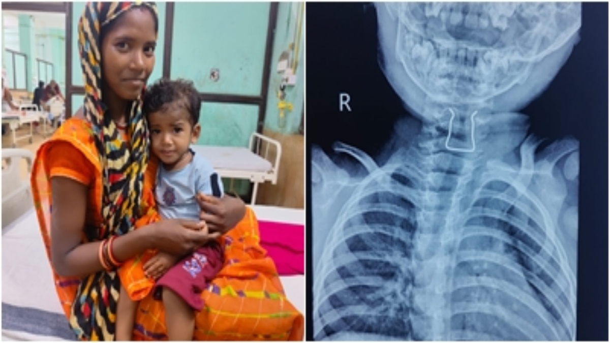 खेल-खेल में मासूम ने निगला तार का टुकड़ा: गले में फंसा तो परिजनों की हलक में अटकी जान, मेडिकल कॉलेज के डॉक्टरों ने जटिल ऑपरेशन कर बचाया