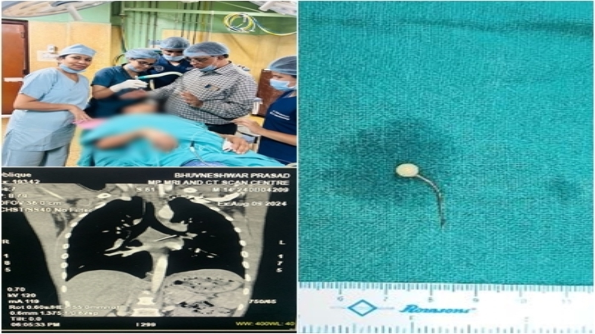 खेल-खेल में बच्चे ने निगल ली 2 इंच की नुकीली पिन: सांस नली से फेफड़े में जा फंसी, डॉक्टरों ने ऐसे बचाई जान