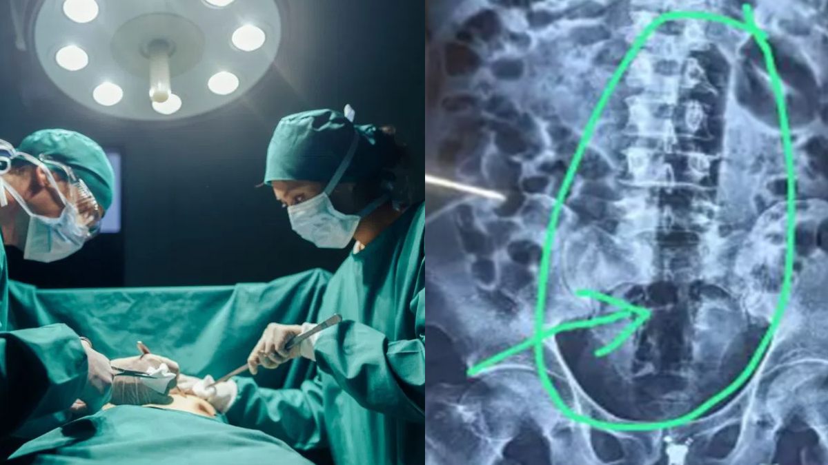 जेल में बंद कैदी ने प्राइवेट पार्ट में डाला 1 फीट लंबा पाइप, हालत गंभीर, डॉक्टरों के उड़े होश