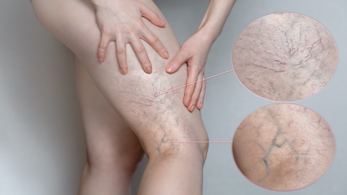 Varicose Veins  है एक गंभीर समस्या, यहां जाने क्या हैं इसके कारण और राहत पाने के तरीके…