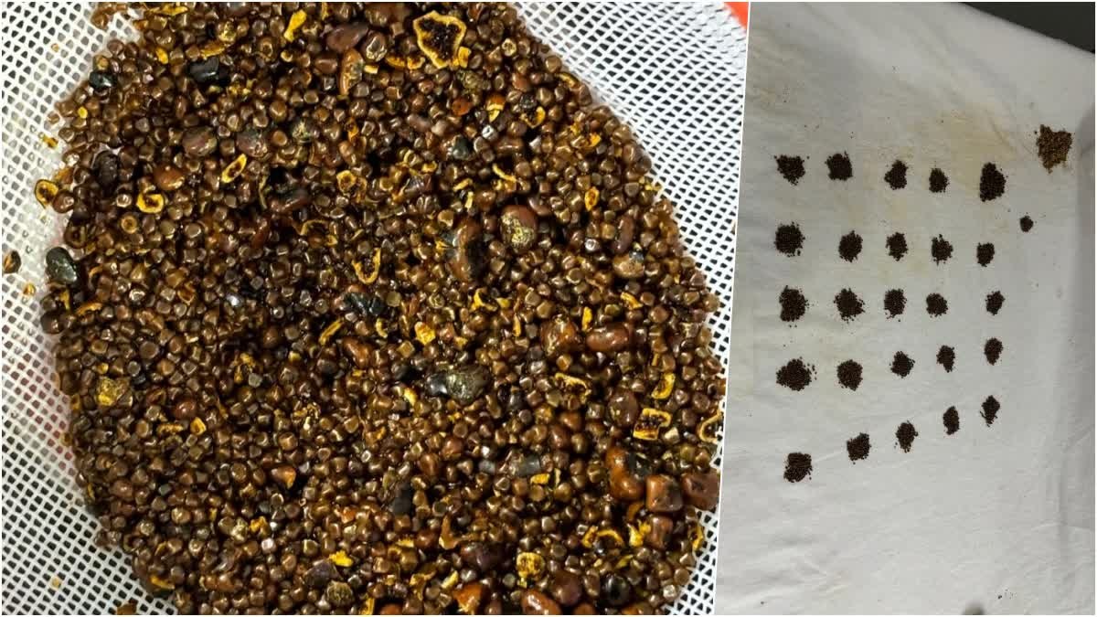 Rajasthan News: कोटा में अनोखा ऑपरेशन: गॉलब्लैडर से निकले 6110 स्टोन्स, गिनने में लगे ढाई घंटे