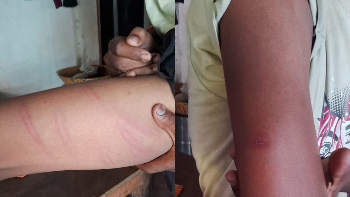 टीचर है या टॉर्चर की मशीन : शिक्षक ने छात्र को डंडे से मारा, हाथ पैर में आई चोट, शिकायत ना करने के लिए दी धमकी