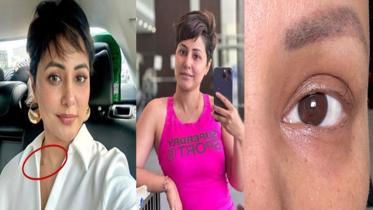 कीमोथेरेपी के बाद उड़ गई Hina Khan की पलकें, मुरझा गया एक्ट्रेस का चेहरा …