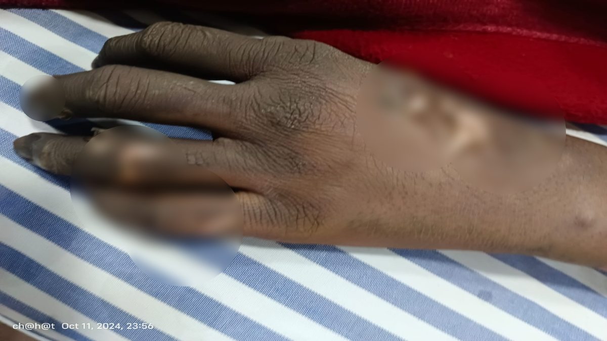 दुर्गा उत्सव पंडाल में बड़ा हादसाः हाईटेंशन बिजली तार की चपेट में आने से 4 लोग झुलसे, एक की हालत गंभीर