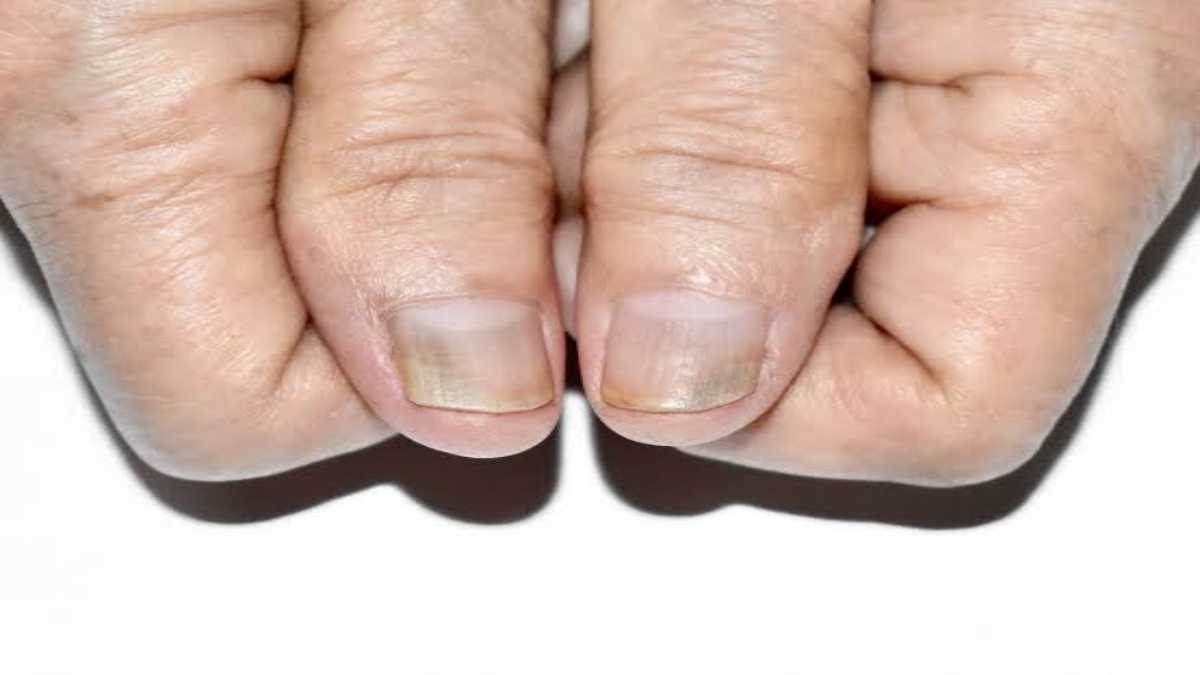 Health Tips: नीले नाखून हो सकते हैं गंभीर समस्या का संकेत, कब लें डॉक्टर से सलाह…