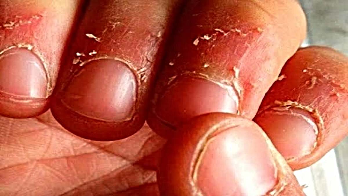 Health Tips: ठंड के मौसम में नाखून के आस-पास की स्किन फटने से हो रही है तकलीफ़, इस तरह पाएं राहत…